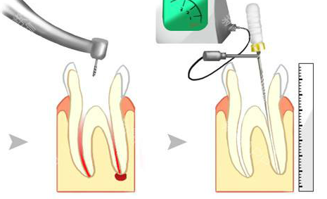 顯微根管治療技術
